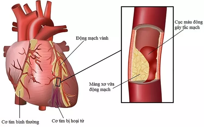 Bệnh mạch vành là tình trạng lòng mạch bị tắc hẹp, cản trở lưu thông máu đến tim.webp